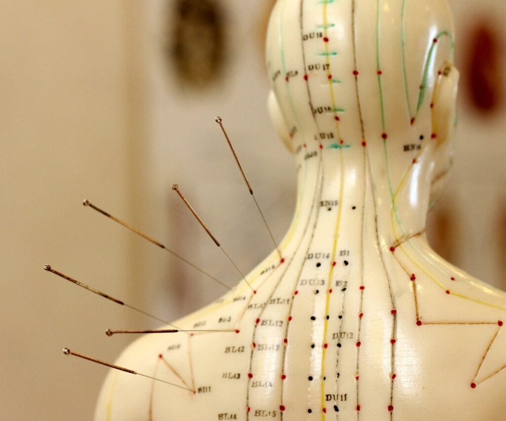Akupunktur als Alternativmedizin
